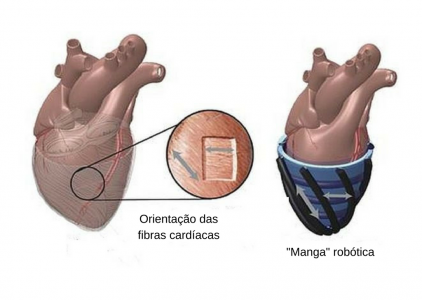 Manga robtica ajuda pacientes com insuficincia cardaca