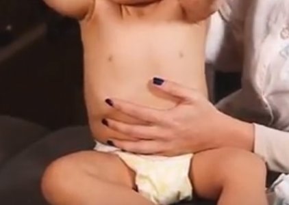 Tratamento de clicas atravs de tcnicas miofasciais (Osteopatia Peditrica) com Sofia Milhano
