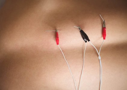 Cuidados, Contraindicaes e Tipos de Aplicao da Eletropuntura