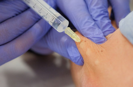 Disfuno do Supra-Espinhoso  pode a Mesoterapia ajudar?