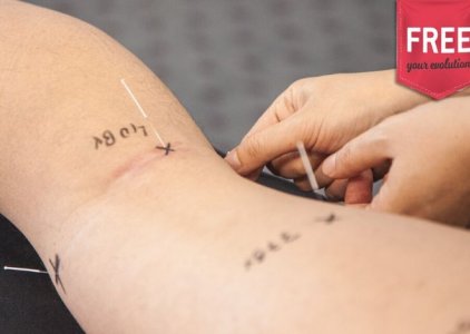 Acupuntura: qual mecanismo de ao?